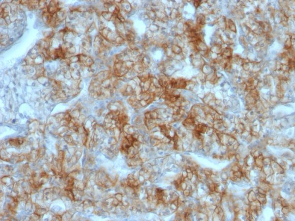 Formalin-fixed, paraffin-embedded human Renal Cell Carcinoma stained with KSP-Cadherin Mouse Monoclonal Antibody (CDH16/1071).