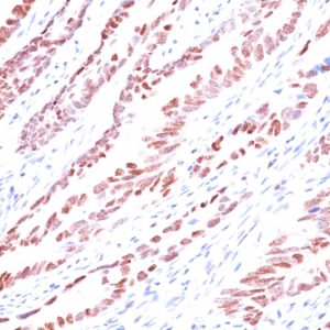 Formalin-fixed, paraffin-embedded human Colon Carcinoma stained with p57 Monoclonal Antibody (KP10).