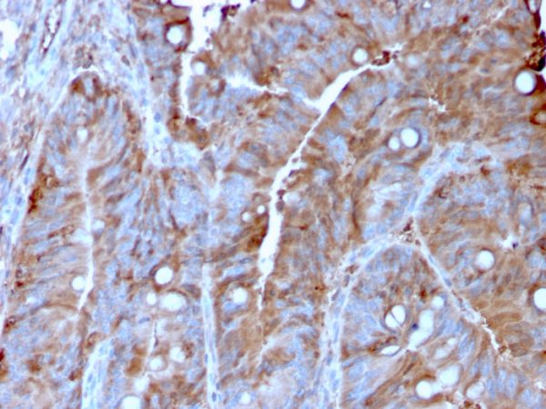 Formalin-fixed, paraffin-embedded human Colon Carcinoma stained with MerTK Mouse Monoclonal Antibody (MERTK/3022).