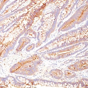 Formalin-fixed, paraffin-embedded human colon carcinoma stained with CEA Mouse Monoclonal Antibody (COL-1).