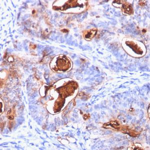 Formalin-fixed, paraffin-embedded human colon carcinoma stained with CEA Mouse Monoclonal Antibody (C66/1260).