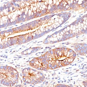 Formalin-fixed, paraffin-embedded human colon carcinoma stained with CEA Mouse Monoclonal Antibody (SPM551).
