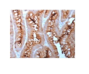 Formalin-fixed, paraffin-embedded human melanoma stained with CEA Rabbit Recombinant Monoclonal Antibody (C66/1983R).