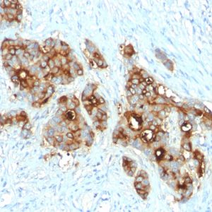 Formalin-fixed, paraffin-embedded human colon carcinoma stained with CEA Rabbit Recombinant Monoclonal Antibody (C66/2055R).