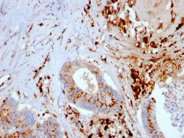 Formalin-fixed, paraffin-embedded human liver carcinoma and macrophages stained with Cathepsin D Mouse Monoclonal Antibody (CTSD/3082).