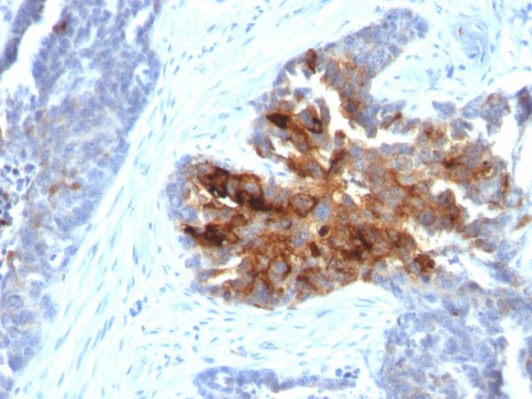 Formalin-fixed, paraffin-embedded human Ovary stained with TAG-72 Rabbit Recombinant Monoclonal Antibody (CA72/2869R).