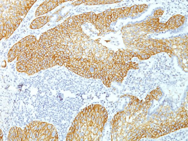 Formalin-fixed, paraffin-embedded human Lung Squamous Cell Carcinoma stained with Desmoglein-3 Monoclonal Antibody (DSG3/1535).