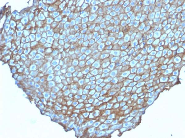 Formalin-fixed, paraffin-embedded human Esophageal Carcinoma stained with Desmoglein-3 Mouse Monoclonal Antibody (DSG3/2838).