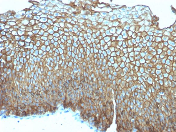 Formalin-fixed, paraffin-embedded human Esophageal Carcinoma stained with Desmoglein-3 Mouse Monoclonal Antibody (DSG3/2839).