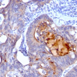 Formalin-fixed, paraffin-embedded human Colon Carcinoma stained with IgA Secretory Component Mouse Monoclonal Antibody (rECM1/792).