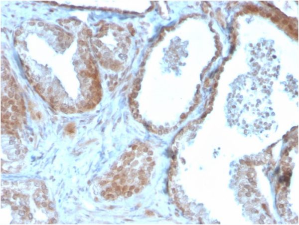 Formalin-fixed, paraffin-embedded human Prostate Carcinoma stained with TIGIT-Monospecific Mouse Monoclonal Antibody (TIGIT/3106).