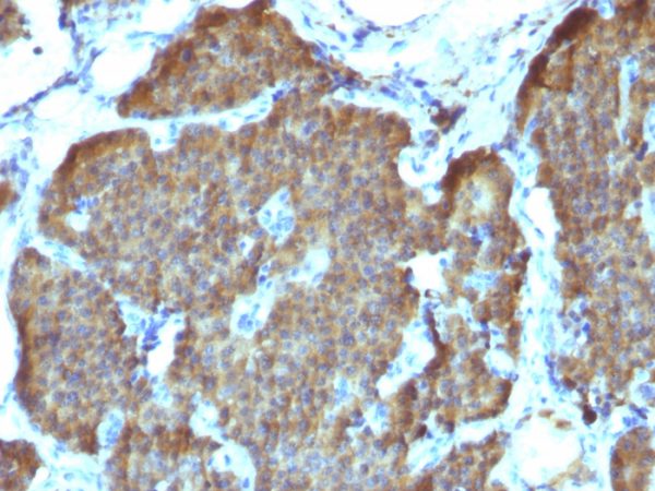 Formalin-fixed, paraffin-embedded human Pheochromocytoma stained with NSE gamma Monoclonal Antibody (SPM347).