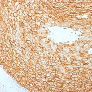 Formalin-fixed, paraffin-embedded human Breast Carcinoma stained with HER-2 Mouse Monoclonal Antibody (ERBB2/2453).