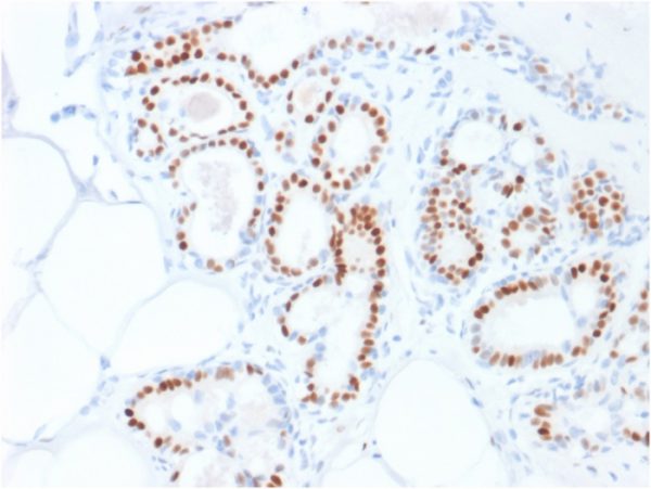 Formalin-fixed, paraffin-embedded human breast carcinoma stained with Estrogen Receptor alpha Mouse Monoclonal Antibody (ESR1/1935).