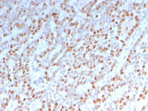 Formalin-fixed, paraffin-embedded human Breast Carcinoma stained with Estrogen Receptor alpha Mouse Monoclonal Antibody (ESR1/3342).