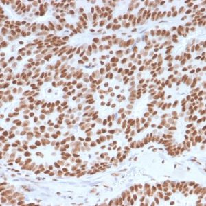 Formalin-fixed, paraffin-embedded human Breast Carcinoma stained with Estrogen Receptor alpha Mouse Monoclonal Antibody (ESR1/3557).