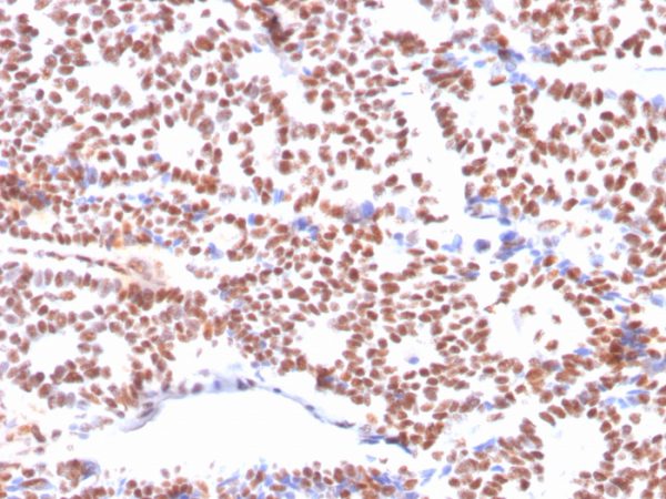 Formalin-fixed, paraffin-embedded human Breast Carcinoma stained with Estrogen Receptor alpha Mouse Monoclonal Antibody (ESR1/3564).
