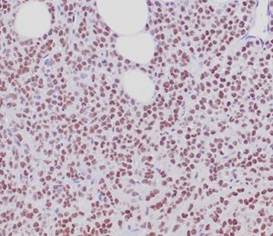 Formalin fixed paraffin embedded human breast carcinoma stained with ER, alpha Rabbit Recombinant Monoclonal Antibody (ESR1/6811R). HIER: Tris/EDTA, pH9.0, 45min. 2°C: HRP-polymer, 30min. DAB, 5min.