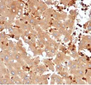 Formalin-fixed, paraffin-embedded human liver metastasized to colon stained with FABP5 Recombinant Rabbit Monoclonal Antibody (FABP5/6353R).