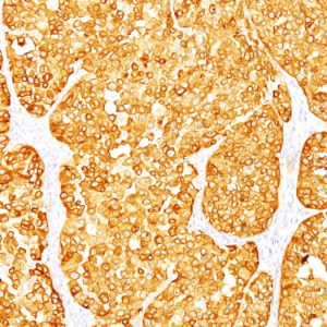 Formalin-fixed, paraffin-embedded human Melanoma stained with MART-1 / Melan-A Mouse Monoclonal Antibody (M2-7C10+M2-9E3).
