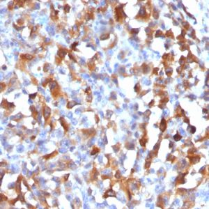 Formalin-fixed, paraffin-embedded human Melanoma stained with MART-1 Rabbit Polyclonal Antibody.