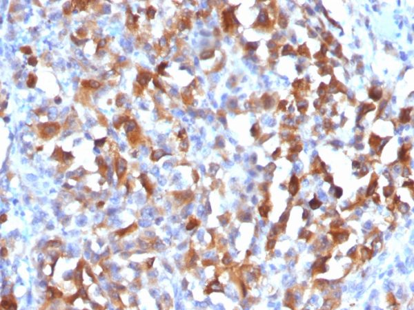 Formalin-fixed, paraffin-embedded human Melanoma stained with MART-1 Rabbit Polyclonal Antibody.