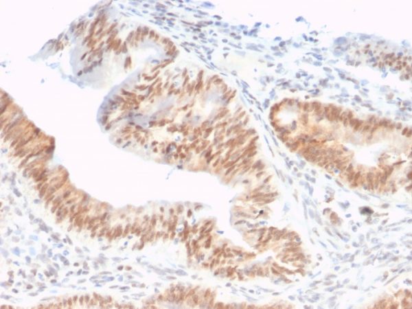 Formalin-fixed, paraffin-embedded human colon adenocarcinoma stained with CSTF2T Mouse Monoclonal Antibody (PCRP-CSTF2T-1A3).