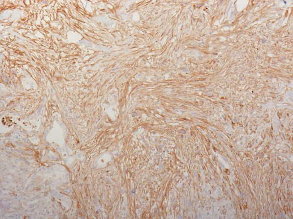 Formalin-fixed, paraffin-embedded human Pancreatic Adenocarcinoma stained with Fibronectin Monoclonal Antibody (HFN7.1).