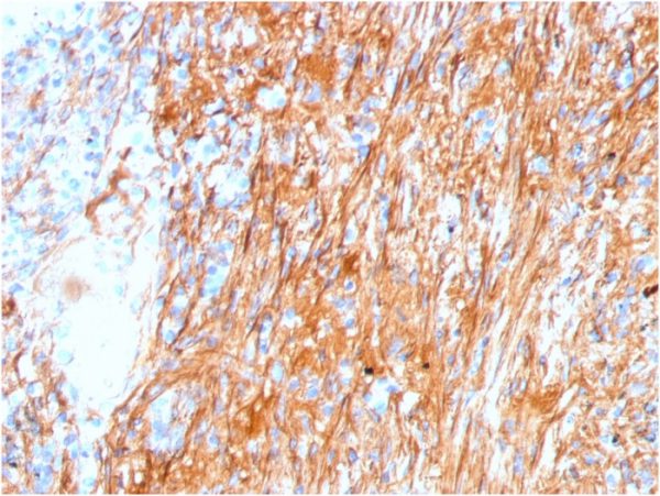 Formalin-fixed, paraffin-embedded human lung stained with Fibronectin Mouse Monoclonal Antibody (FN1/3045).