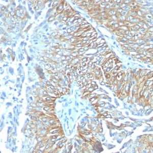 Formalin-fixed, paraffin-embedded human Lung SqCC stained with TRIM29 Mouse Monoclonal Antibody (TRIM29/1041).