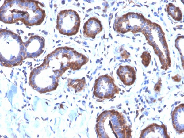 Formalin-fixed, paraffin-embedded human Breast Carcinoma stained with Ferritin LC Rabbit Recombinant Monoclonal Antibody (FTL/2338R).