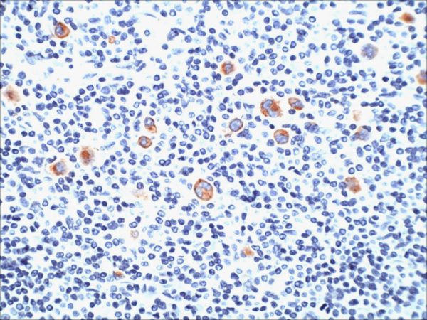 Formalin-fixed, paraffin-embedded human Hodgkin‚Äôs Lymphoma stained with CD15 Monoclonal Antibody (SPM490)