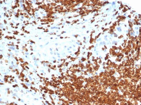 IHC analysis of formalin-fixed, paraffin-embedded human bladder carcinoma. AMH/6713R at 2ug/ml in PBS for 30min RT. HIER: Tris/EDTA, pH9.0, 45min. 2°C: HRP-polymer, 30min. DAB, 5min.