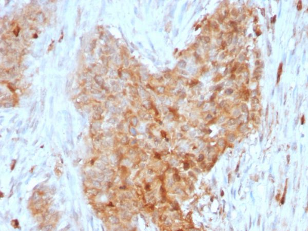 Formalin-fixed, paraffin-embedded human Breast Carcinoma stained with GPI Mouse Monoclonal Antibody (CPTC-GPI-1).