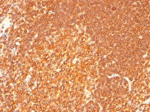 Formalin-fixed, paraffin-embedded human Tonsil stained with HLA-DR Monoclonal Antibody (LN-3 + HLA-DRB/1067).