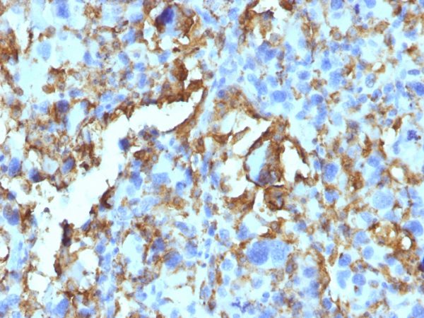 Formalin-fixed, paraffin-embedded human Histiocytoma stained with HLA-DR Monoclonal Antibody (LN-3 + HLA-DRB/1067).