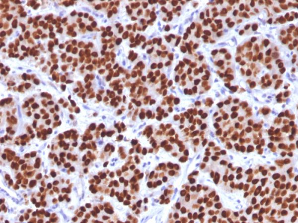 Formalin-fixed, paraffin-embedded human prostate carcinoma stained with FOXA1 Mouse Monoclonal Antibody (FOXA1/1512).