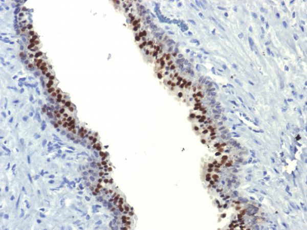 Formalin-fixed, paraffin-embedded human Prostate Carcinoma stained with FOXA1  Monoclonal Antibody (FOXA1/1514).