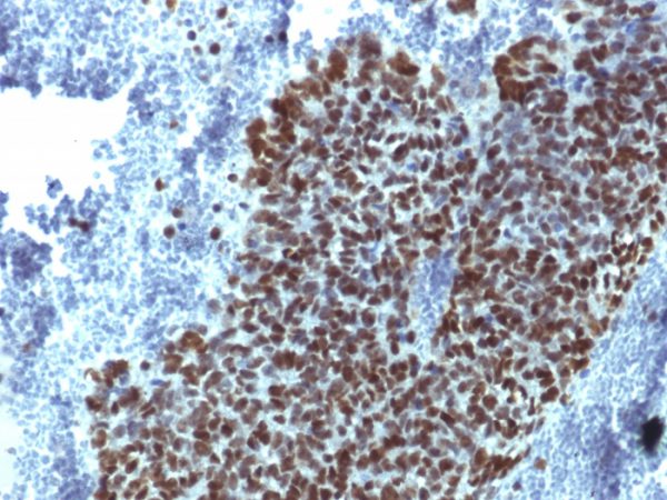 Formalin-fixed, paraffin-embedded human Prostate  Carcinoma stained with FOXA1 Mouse Monoclonal Antibody (FOXA1/1541).