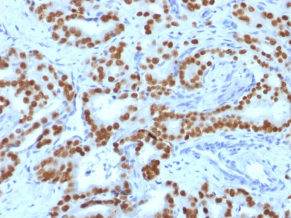 Formalin-fixed, paraffin-embedded human prostate carcinoma stained with FOXA1 Mouse Monoclonal Antibody (FOXA1/1519).