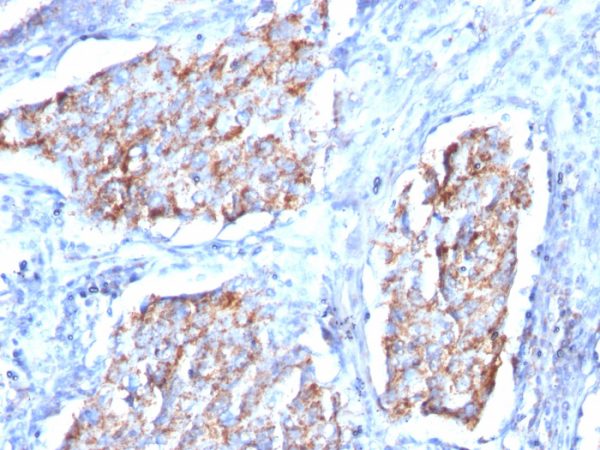 Formalin-fixed, paraffin-embedded human Lung Carcinoma stained with HSP60 Mouse Monoclonal Antibody (HSPD1/780)