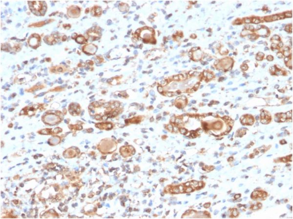 Formalin-fixed, paraffin-embedded human renal cell carcinoma stained with HSP60 Mouse Monoclonal Antibody (CPTC-HSPD1-1).