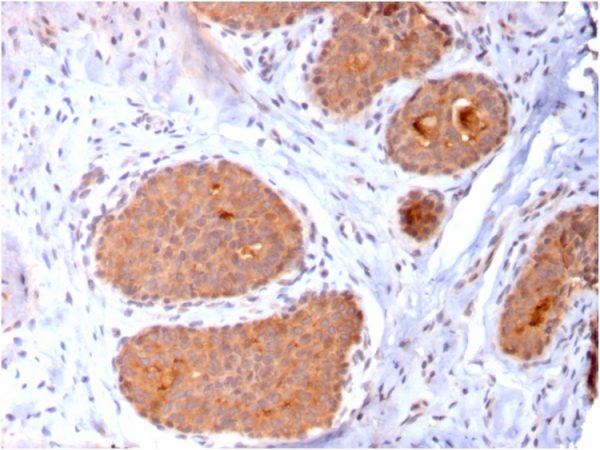 Formalin-fixed, paraffin-embedded human breast carcinoma stained with HSP60 Mouse Monoclonal Antibody (CPTC-HSPD1-1).