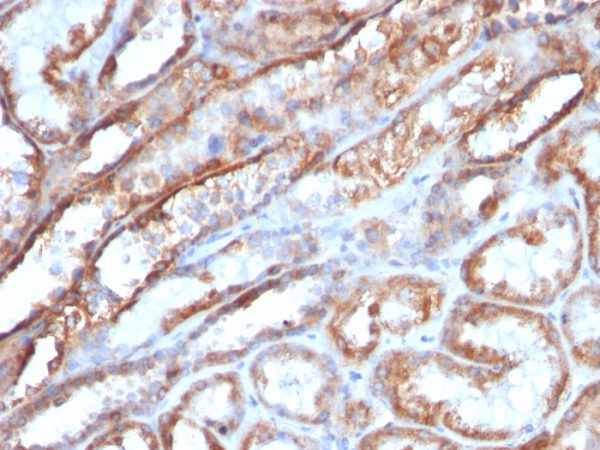 Formalin-fixed, paraffin-embedded human Renal Cell Carcinoma stained with HSP60 Mouse Monoclonal Antibody (AE-1).