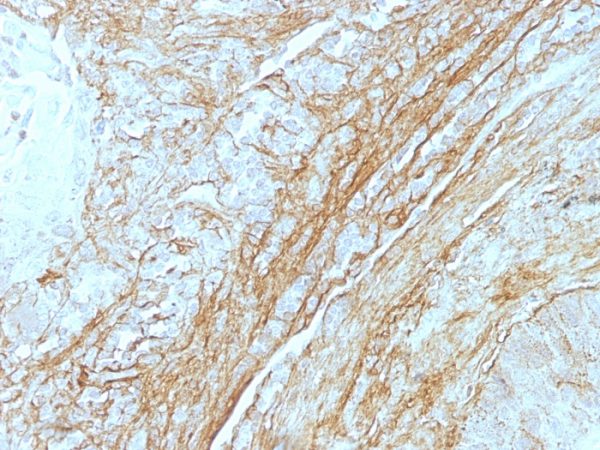 Formalin-fixed, paraffin-embedded human Lung Carcinoma stained with Tenascin C Monoclonal Antibody (T2H5). Note staining of connective tissue.