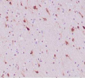 FFPE human glioblastoma with IDH1-R132H mutation stained with  IDH1-R132H Recombinant Rabbit Monoclonal Antibody (IDH1/6806R). HIER: Tris/EDTA, pH9.0, 45min. 2°C: HRP-polymer, 30min. DAB, 5min.