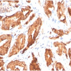 Formalin-fixed, paraffin-embedded human prostate carcinoma stained with PSA Recombinant Rabbit MonoclonalAntibody (KLK3/4602R).