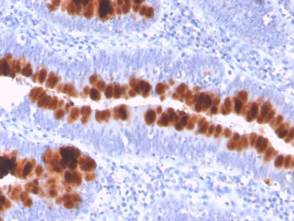 Formalin-fixed, paraffin-embedded human colon stained with CD95 Mouse Monoclonal Antibody (FAS/3112).