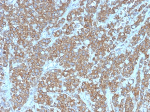 Formalin-fixed, paraffin-embedded human colon carcinoma stained with Interleukin-1 alpha (IL-1A) Mouse Monoclonal Antibody (IL1A/3981).