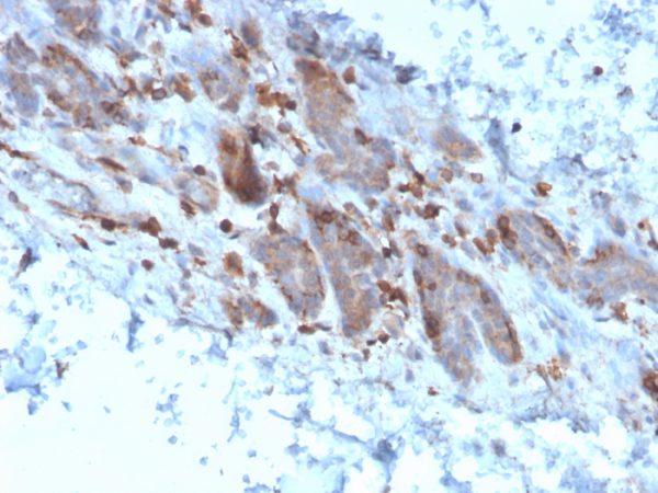 Formalin-fixed, paraffin-embedded human colon carcinoma stained with Interleukin-1 alpha (IL-1A) Mouse Monoclonal Antibody (IL1A/3982).